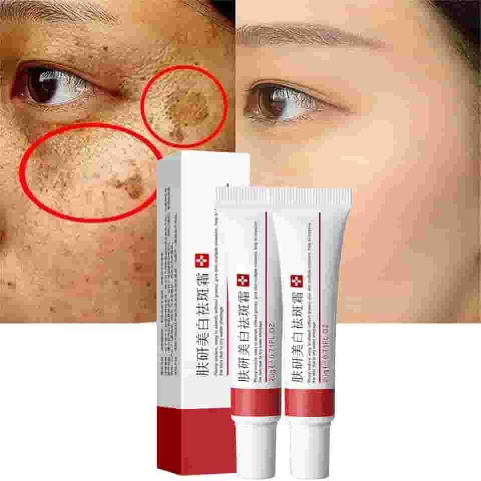 fupah Peças de Creme Clareador para Sardas, Creme de Tratamento para Remoção de Cicatrizes de Acne, Creme para Remoção de Pigmentação para Rosto, Hidratante Remove Melasma Facial, Manchas Escuras, Rugas e Manchas (Creme Clareador para Sardas)